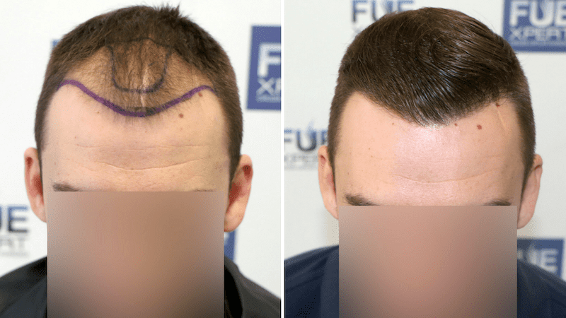 Antes y Después - 2700 UFs Trasplante capilar FUE - FUExpert Clinic - Dr Couto
