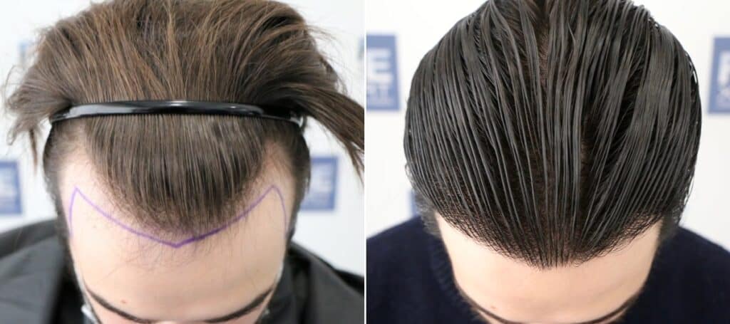 Antes-y-Despues-2200-Injertos-Trasplante-capilar-FUE-Dr-Juan-Couto-en-clinica-capilar-FUExpert-Clinic-Madrid-Espana